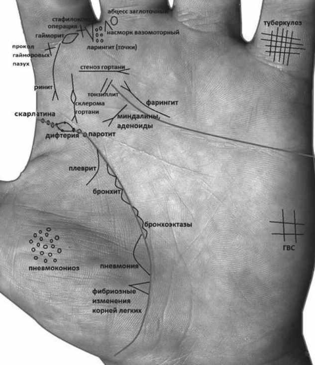 Знаки онкологии на ладони хиромантия фото